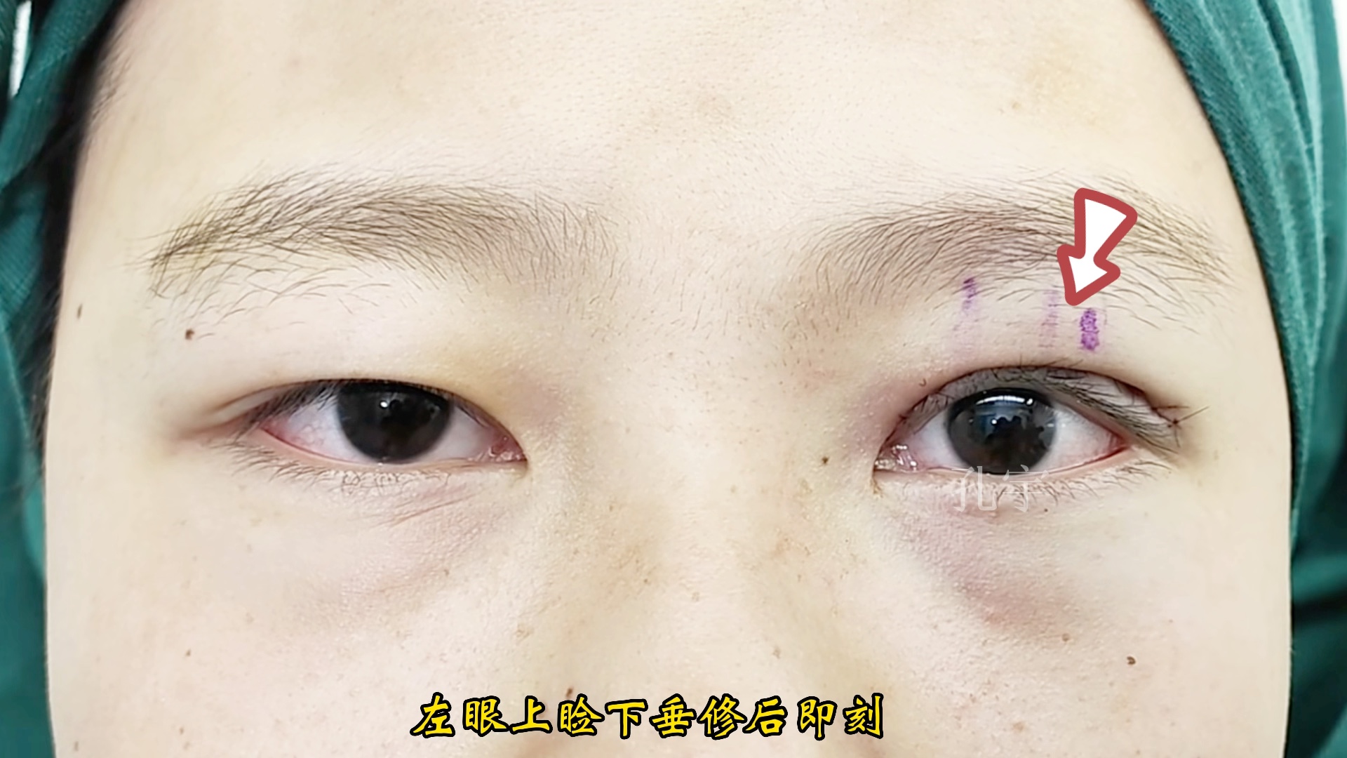 12岁小伙子左眼先天性上睑下垂修复