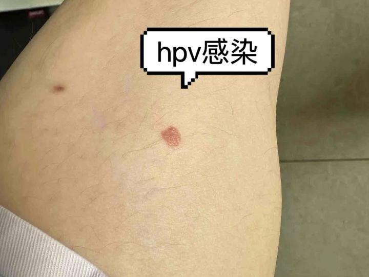 男性hpv 初期图片