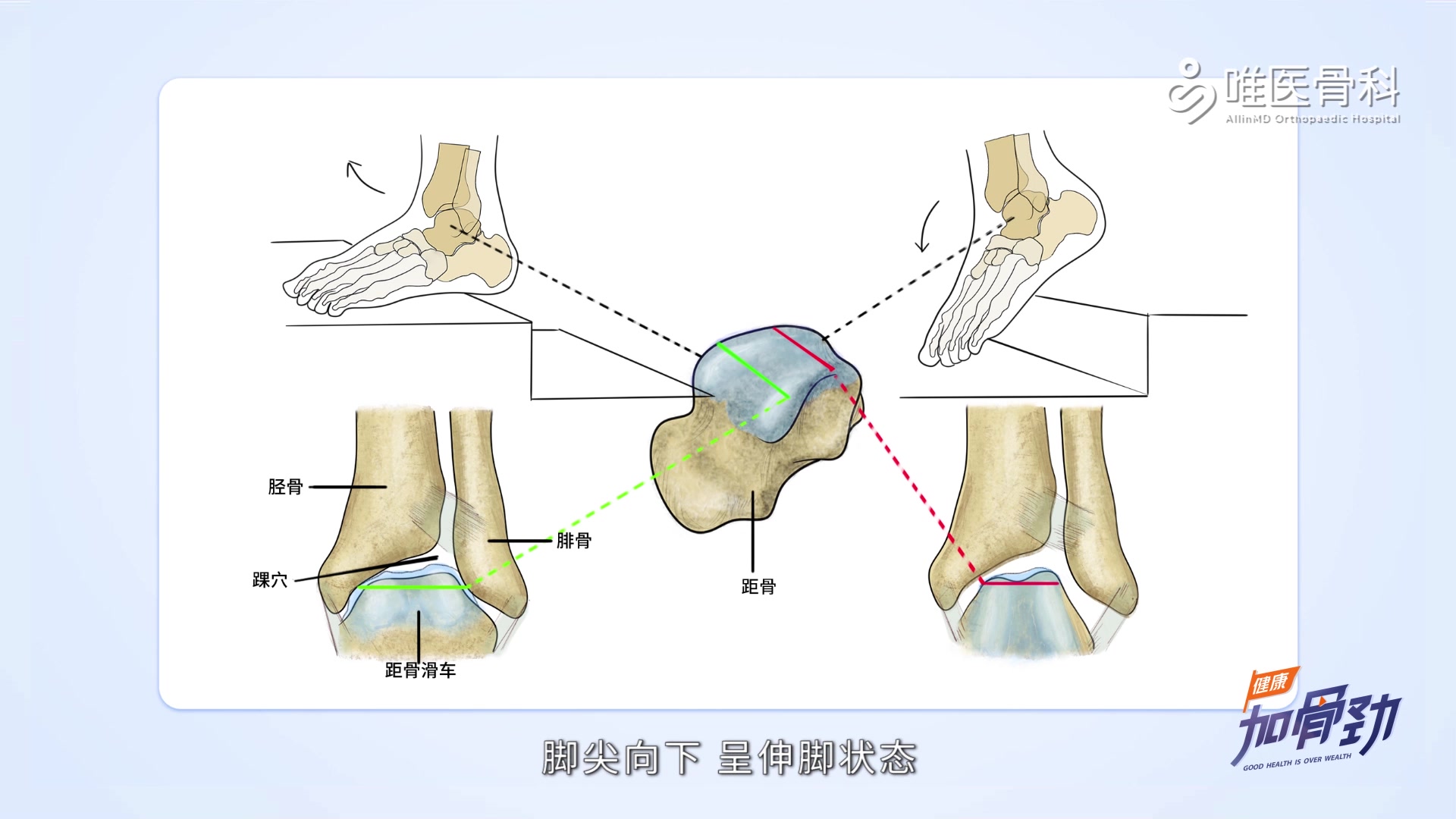 重庆唯医骨科医院赵辉提醒:踝创伤性关节炎是每个人必须了解的哔哩哔哩bilibili