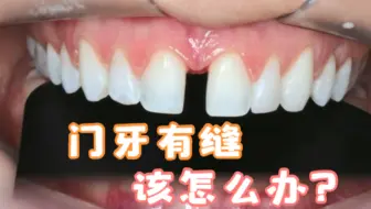 门牙有缝，矫正费时费力嫌麻烦，做牙套又要磨牙，我到底该怎么办