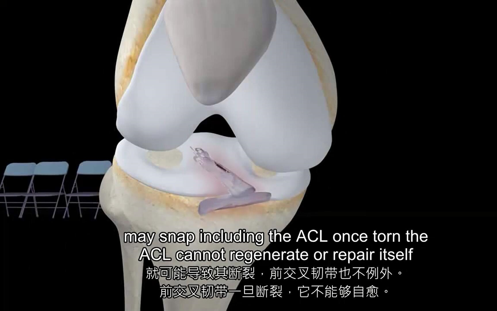 1、ACL重建(英语中文字幕)哔哩哔哩bilibili