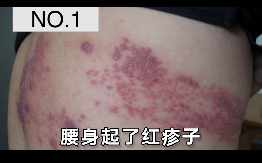 NO15:得了蛇缠腰 这几个方法简单有效哔哩哔哩bilibili