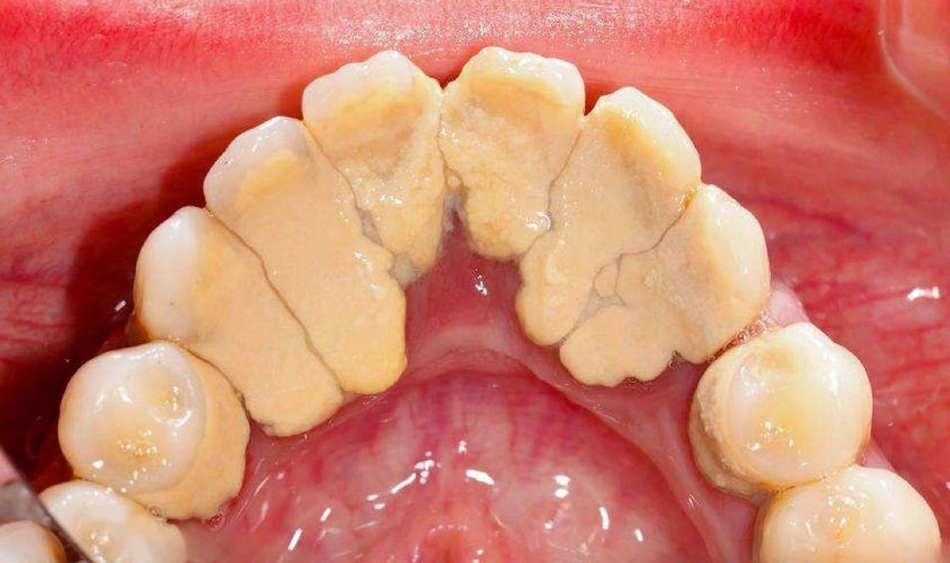 过来人分享去牙黄牙结石2大步骤!低成本见效快,确定不试试?