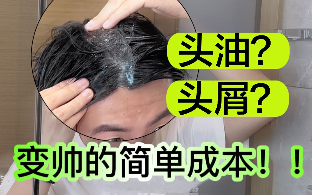 脱发头油?这都是螨虫在头上做窝了!!哔哩哔哩bilibili