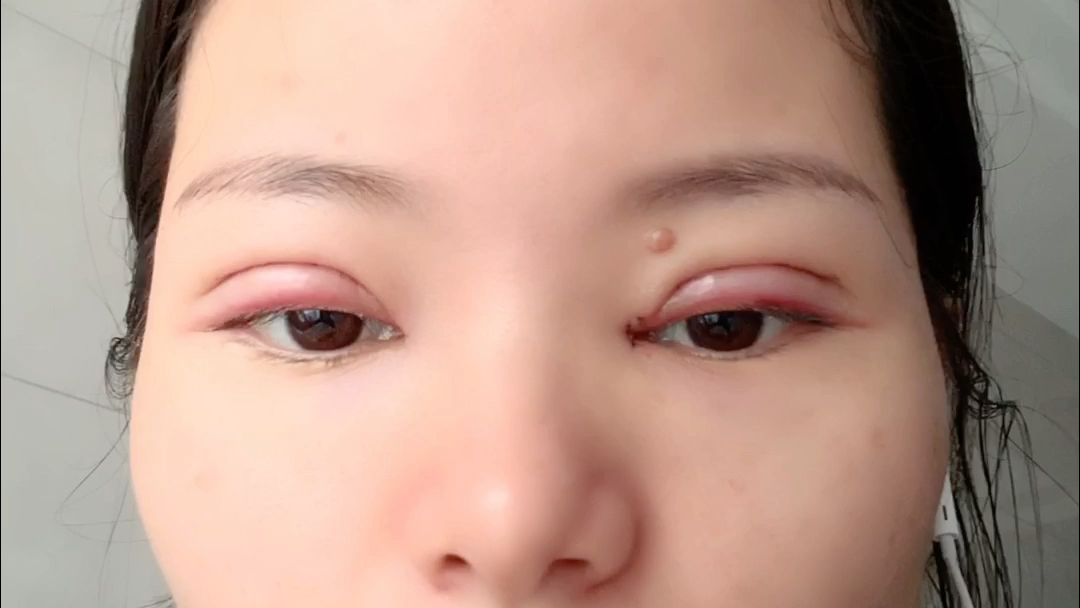 微创双眼皮手术_哔哩哔哩 (゜-゜)つロ 干杯~-bilibili