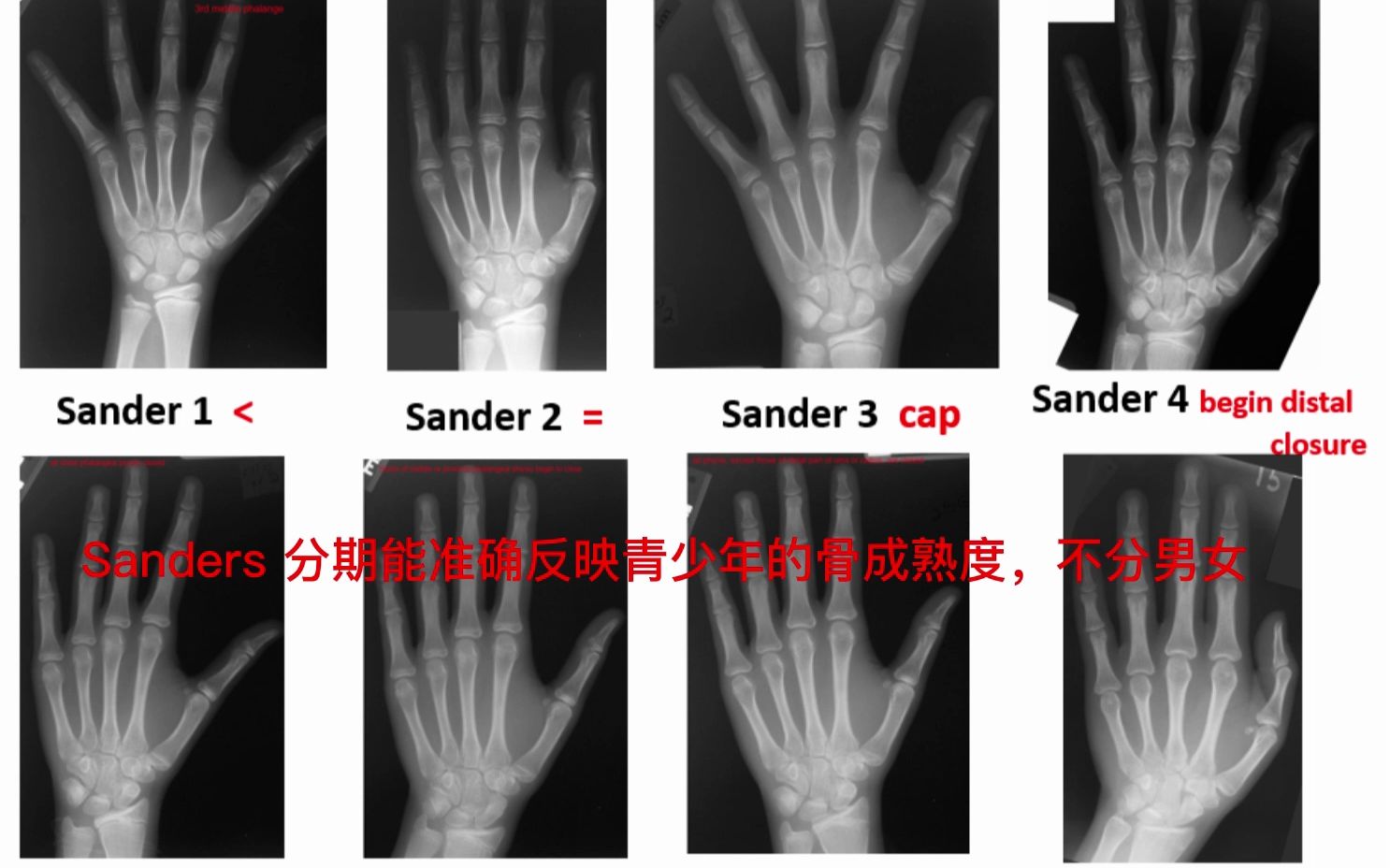 您还能继续长高吗?怎么判断?答案来了哔哩哔哩bilibili