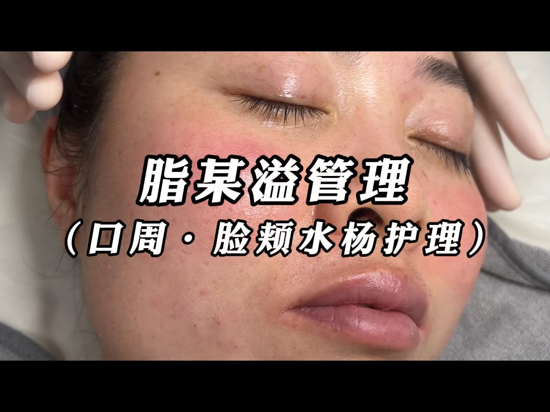 嘴巴也能上水杨吗?!看看这种情况如何正确护理呢哔哩哔哩bilibili