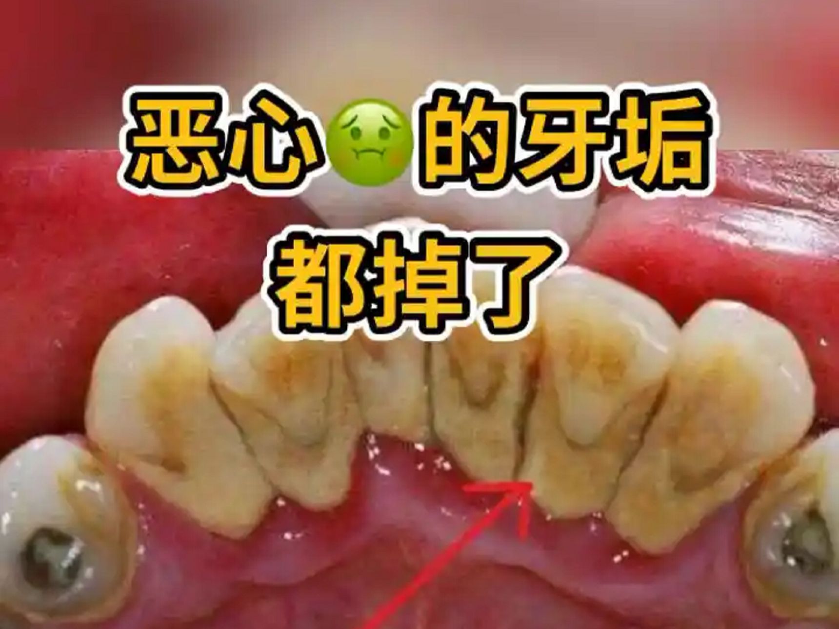 牙齿为什么会长结石