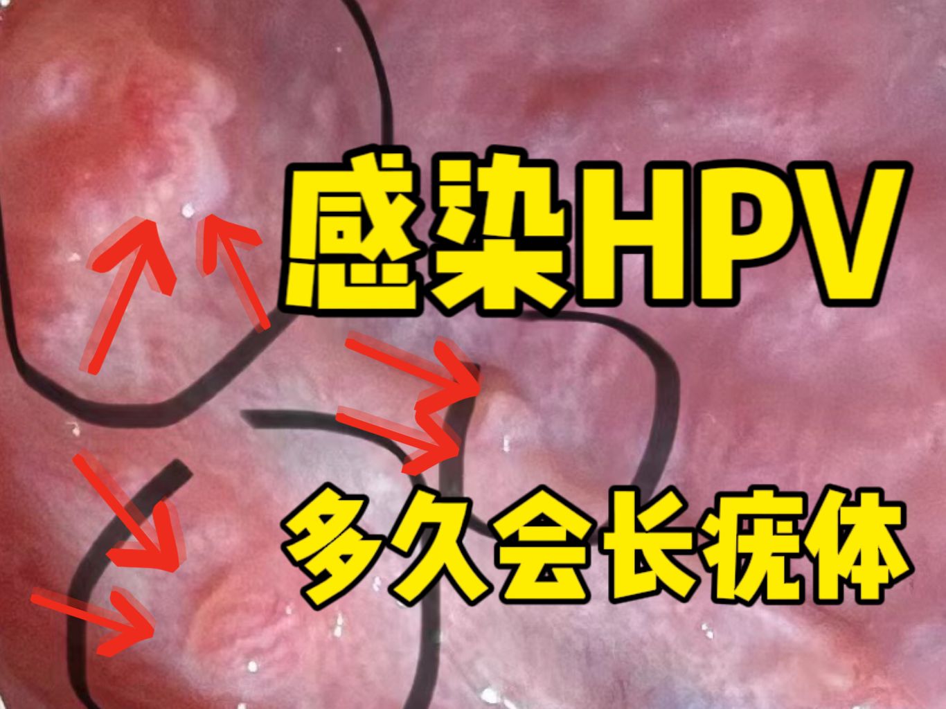 感染hpv后可能长达一年才会引起皮肤症状,长出尖锐湿疣