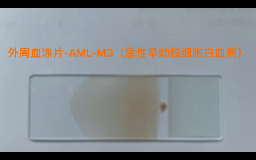 外周血涂片AMLM3(急性早幼粒细胞白血病)哔哩哔哩bilibili