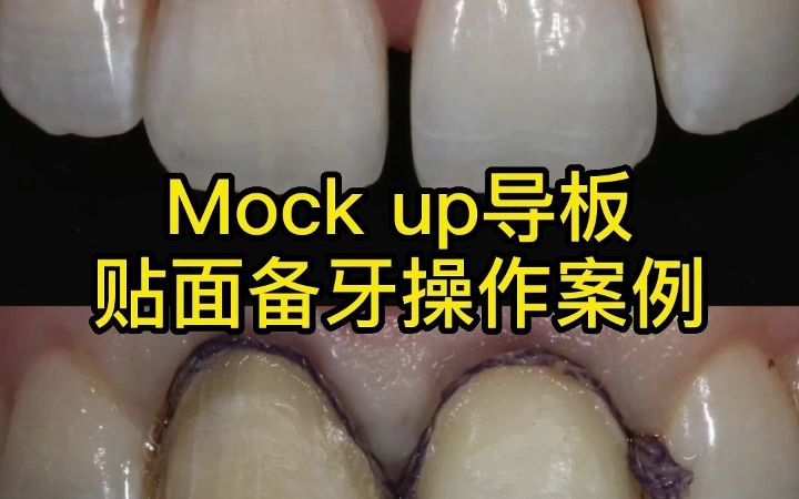 Mock up导板下贴面预备关键点哔哩哔哩bilibili