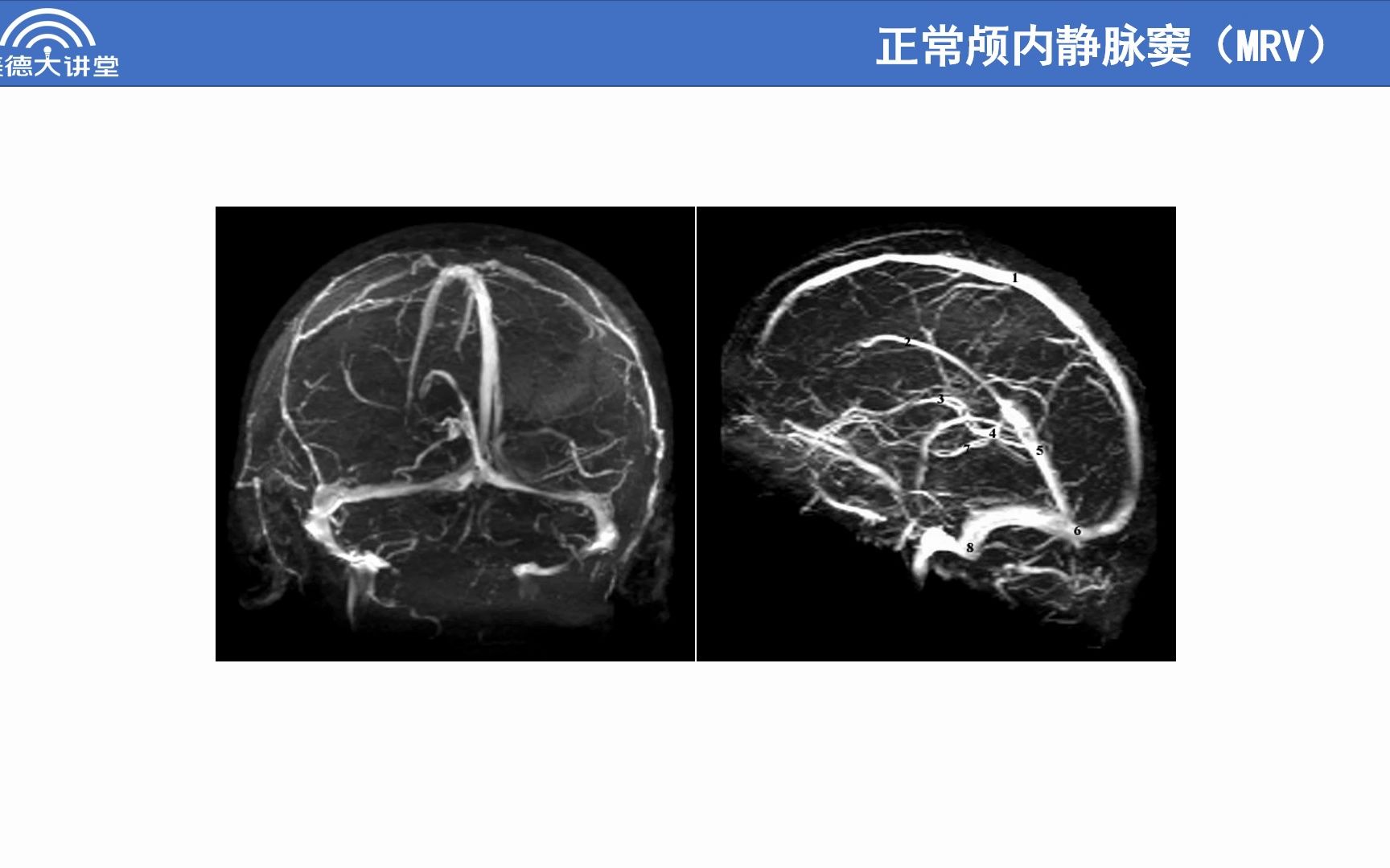 【第四讲】静脉窦血栓的影像诊断 自用网课哔哩哔哩bilibili