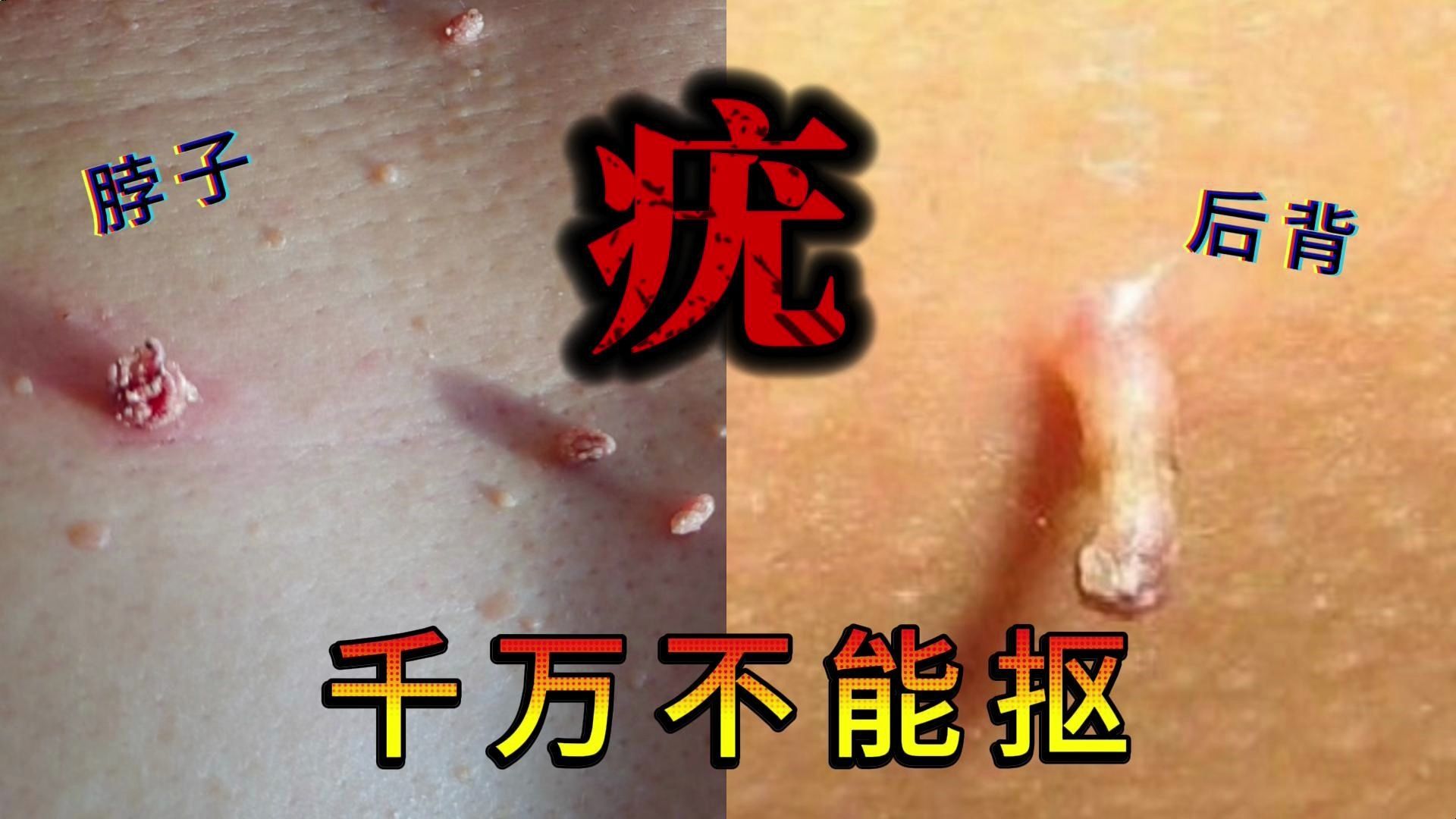 【一招消除皮肤疣】身上的小肉揪千万别抠!hpv感染越抠越多!