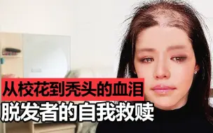 Download Video: 脱发校花的自我救赎?是怎么秃头变丑女的,与头发抗争的10年