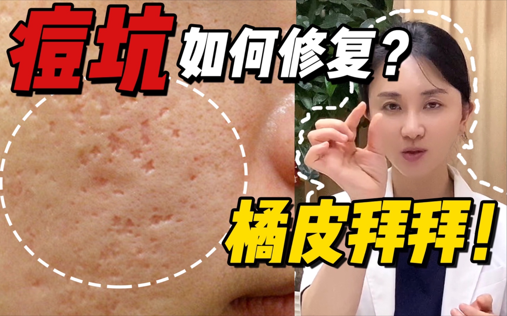 【皮肤医生张琳琳】拯救橘皮!痘坑怎么平?3大类型对应修复方案!