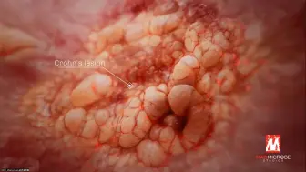 Download Video: Crohn's disease 克罗恩病