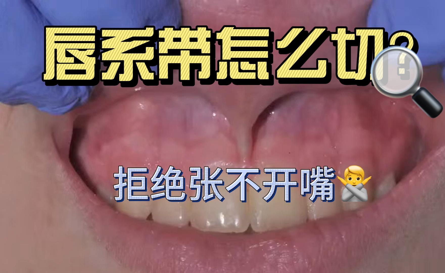 唇系带长变短,笑容大不同!系带延长手术全揭秘哔哩哔哩bilibili