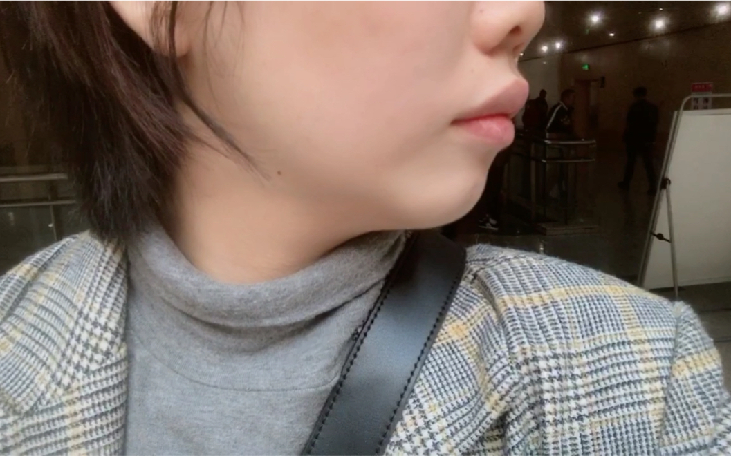 深覆合骨性二类嘴凸下巴后缩矫正第9个月