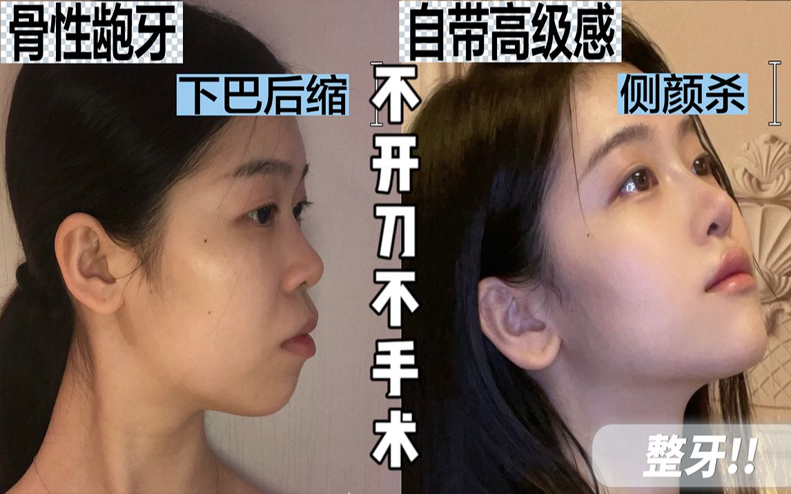 「骨龅」嘴凸不敢动正颌手术,我还有其他选择吗?哔哩哔哩bilibili