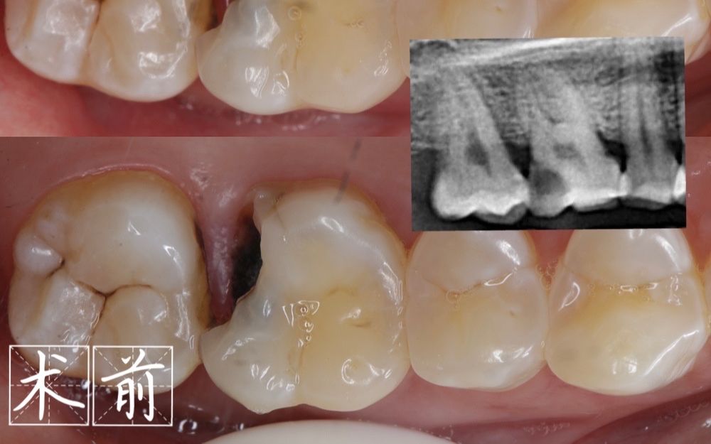 深龋从直接盖髓到树脂充填哔哩哔哩bilibili