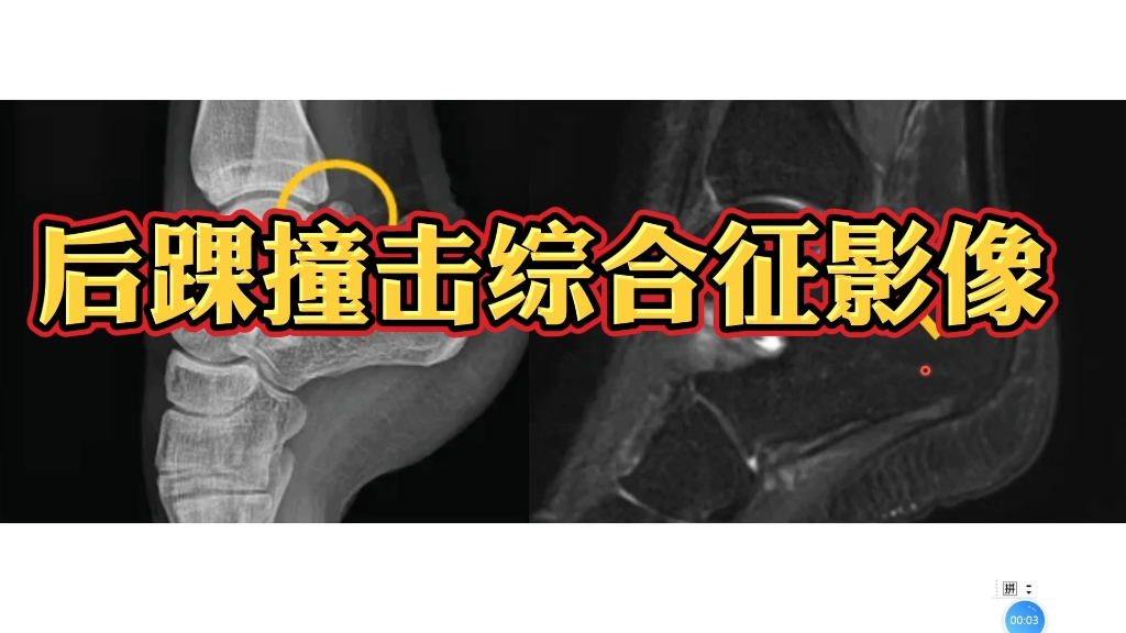 距骨后三角骨综合征影像表现分享,简单易懂!