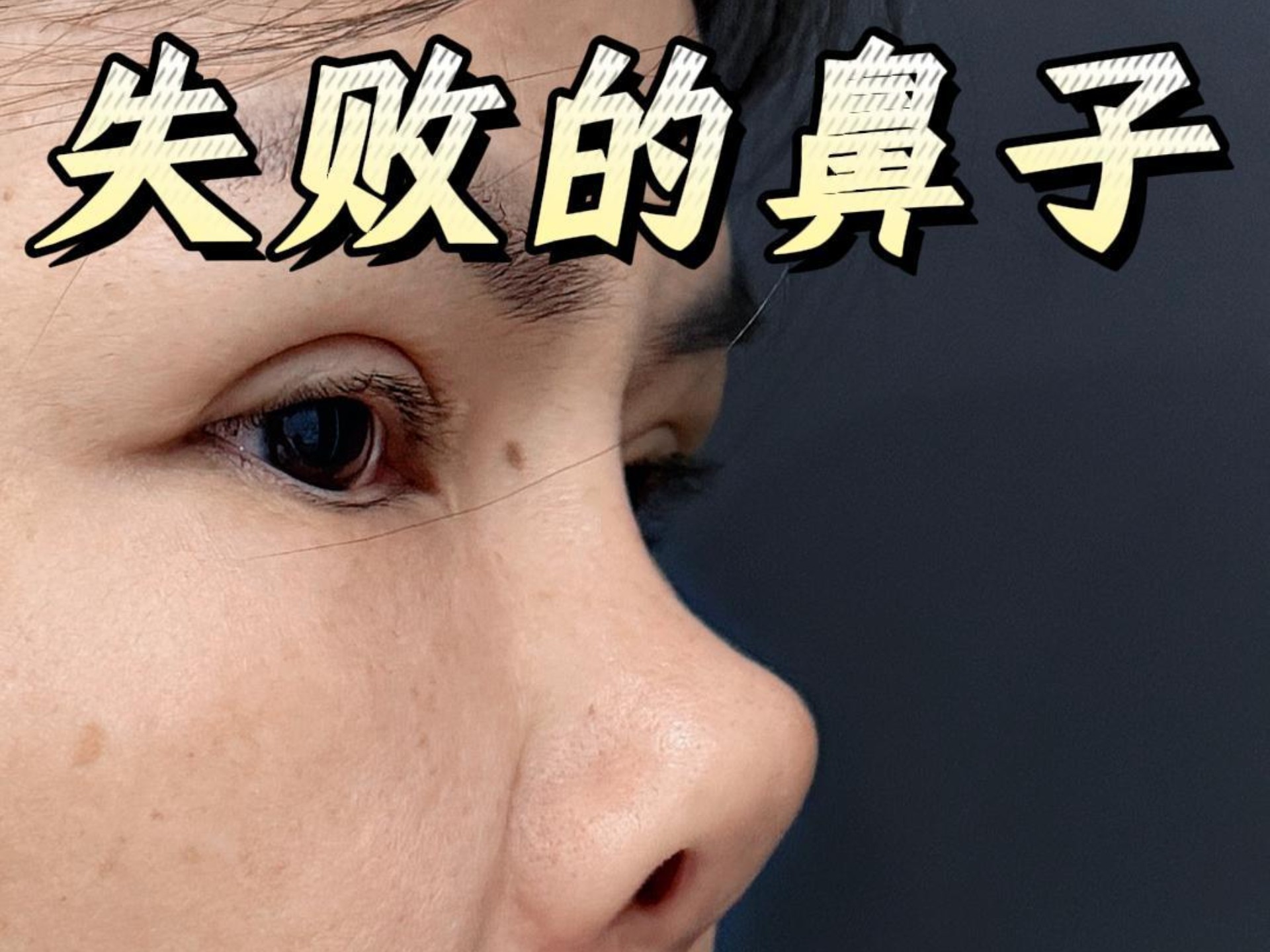 硅胶鼻挛缩修复