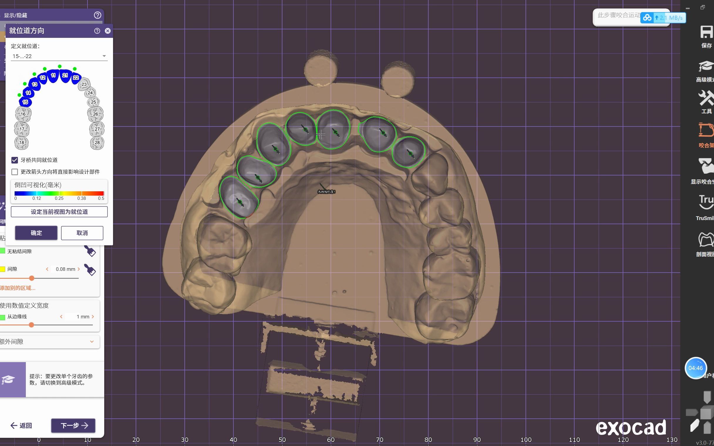 exocad内冠前牙连桥设计教程哔哩哔哩bilibili