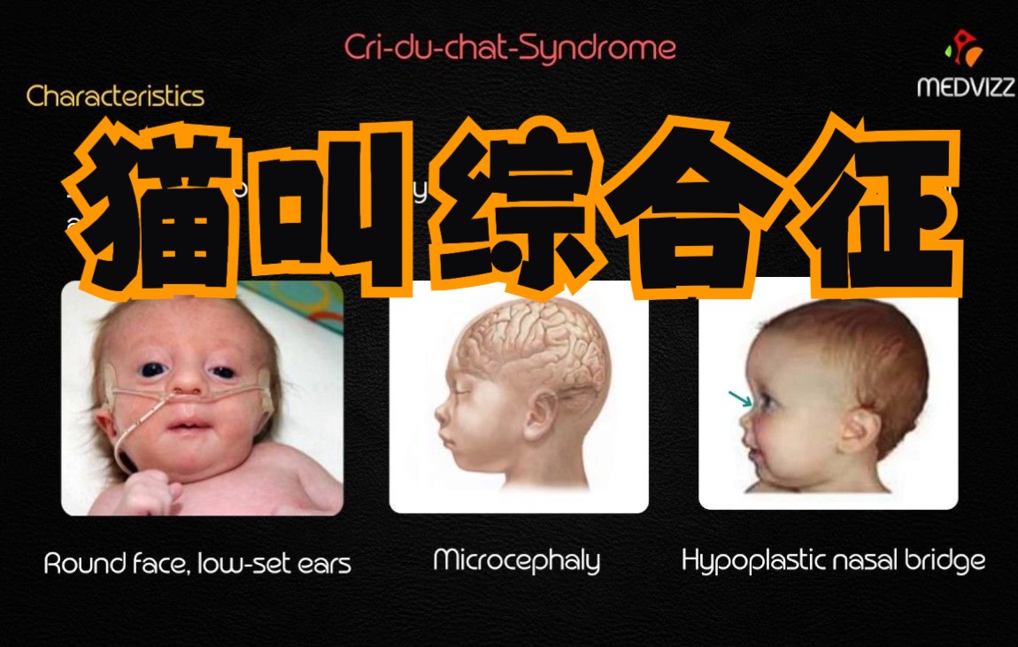 【全英】猫叫综合征 CriduChat Syndrome  Usmle step 1 lecture哔哩哔哩bilibili