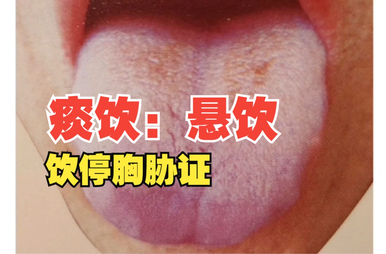 痰饮:悬饮:饮停胸胁证哔哩哔哩bilibili