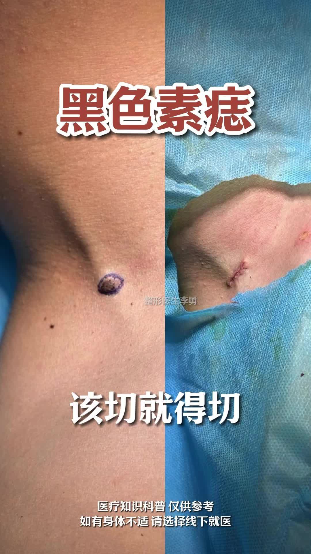 黑色素质手术切除