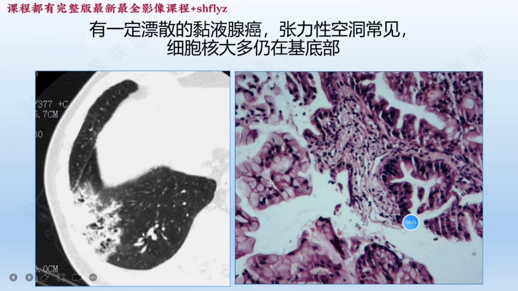 肺结节CT影像及病理进阶班共28讲01:黏液腺癌结节期病理影像分析(王兆宇)哔哩哔哩bilibili