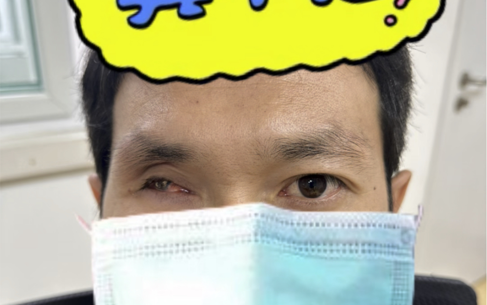 小时候放炮崩伤,近几年眼球慢慢萎缩变色.