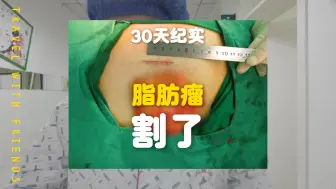 脂肪瘤 割了 ！ 1-30 天康复 vlog