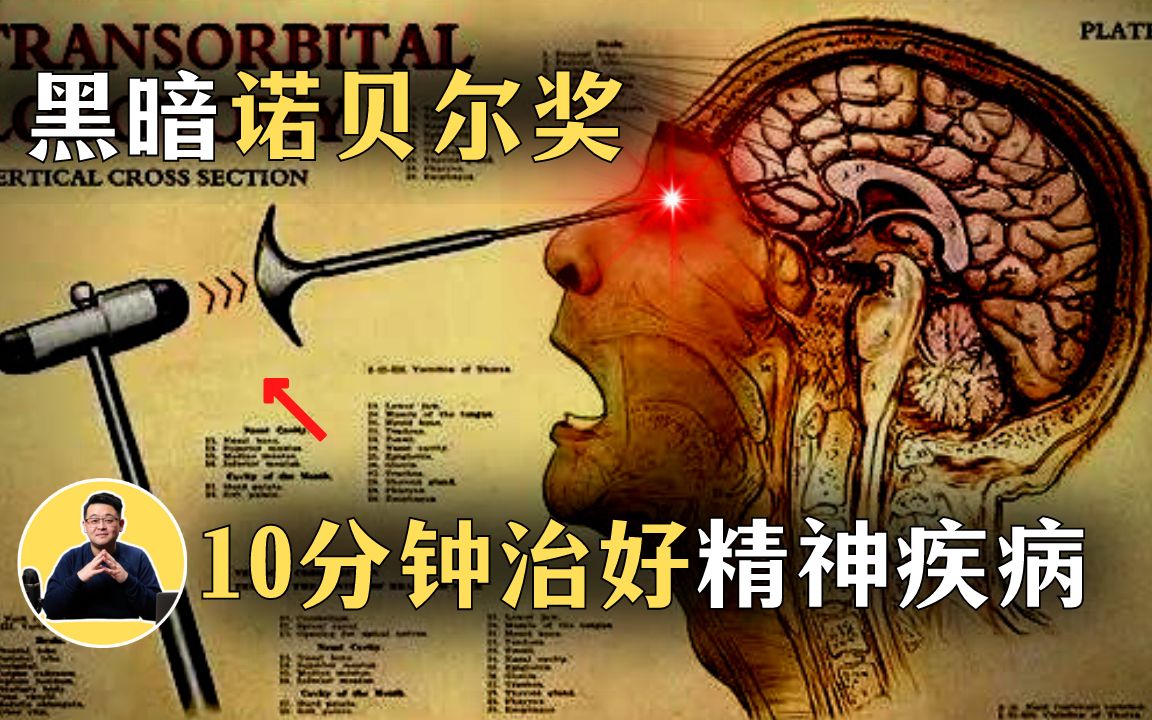 [图]荒唐庸医：10分钟彻底治疗精神疾病，这是治疗方案。据说脑白质切除术，最黑暗的神经科手术，但却获得了诺贝尔奖。警告：危险操作，非医疗建议，请勿模仿！