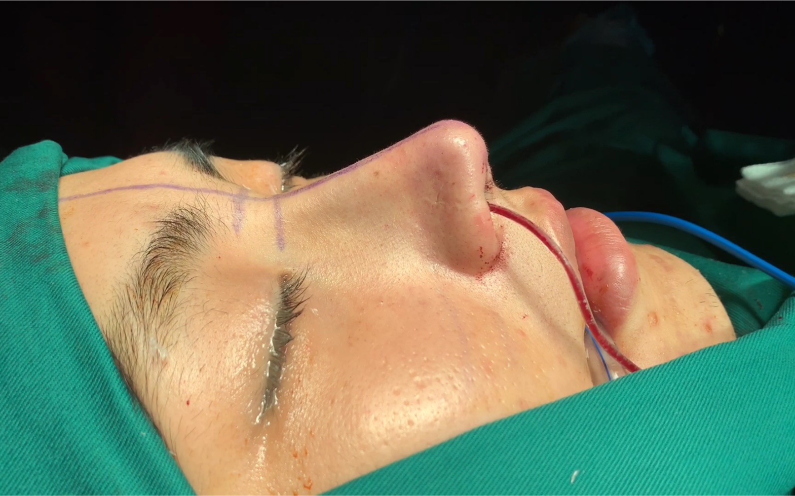 做一次肋骨鼻鼻综合隆鼻的全过程记录手术要经过哪些部分