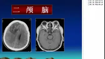 阿虎医考CT医师考试--考点精讲课-颅脑