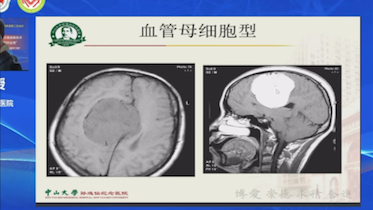 [图]（自学）脑膜瘤常见与少见征象认识