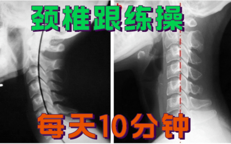 颈椎恢复操,跟练版,保姆级教学,练完真的会很轻松哔哩哔哩bilibili