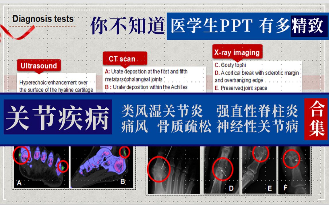 【医学生】你不知道医学生ppt有多精致.关节疾病PPT集合类风湿关节炎,强直性脊柱炎,痛风,骨质疏松和神经性关节炎.哔哩哔哩bilibili