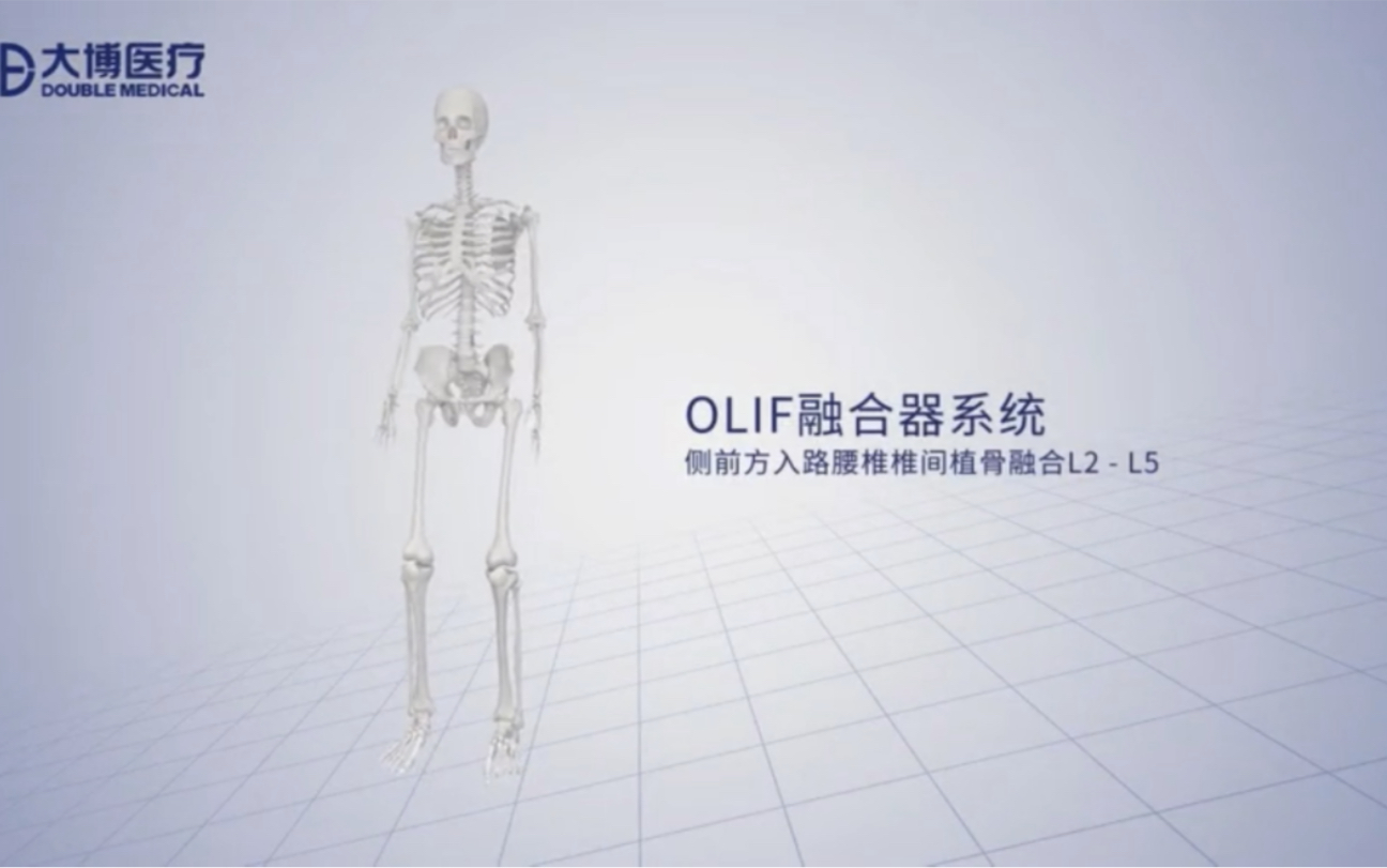 Olif侧前方入路腰椎椎间融合术哔哩哔哩bilibili