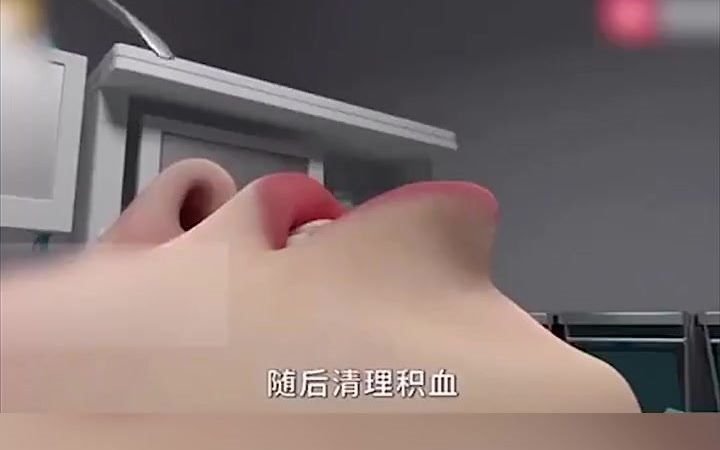 假体隆下巴哔哩哔哩bilibili