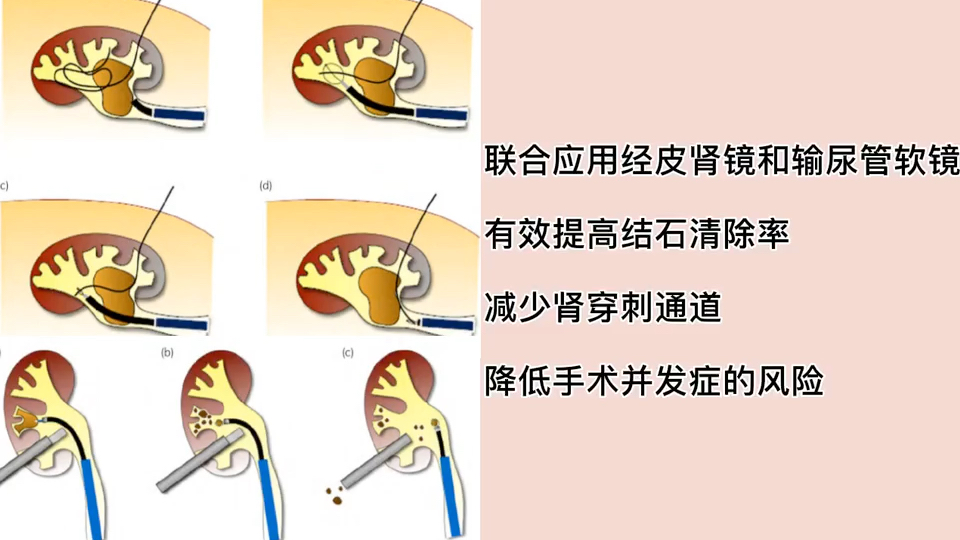 2020三院新技术 | 复杂性肾结石占据肾脏——多镜联合碎石取石术清除结石哔哩哔哩bilibili