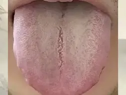 Скачать видео: 舌中有裂纹，病根不在脾胃！你来发舌象，我帮你分析👅