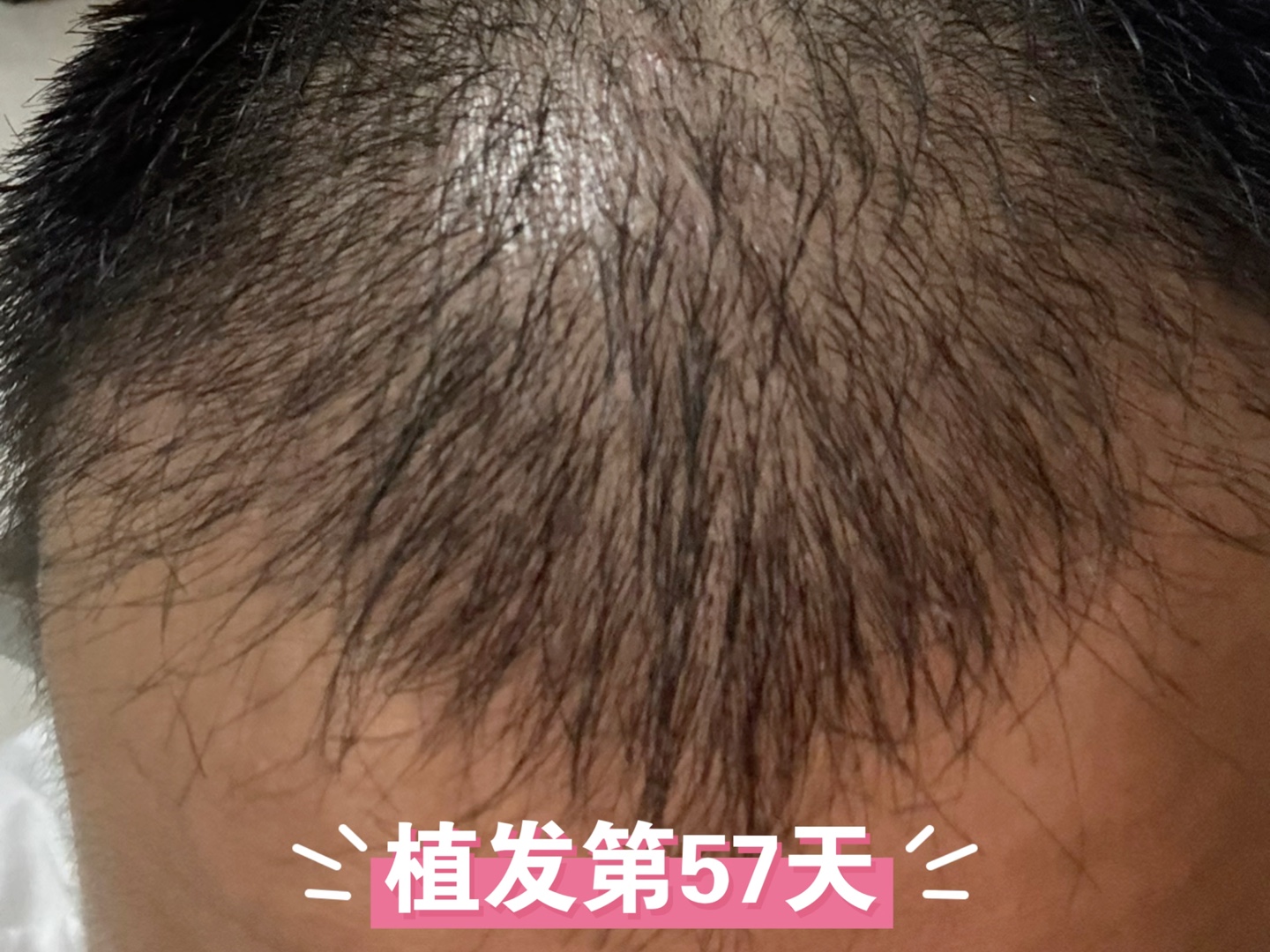植发能不能再长出来(植发到底能不能长出来)