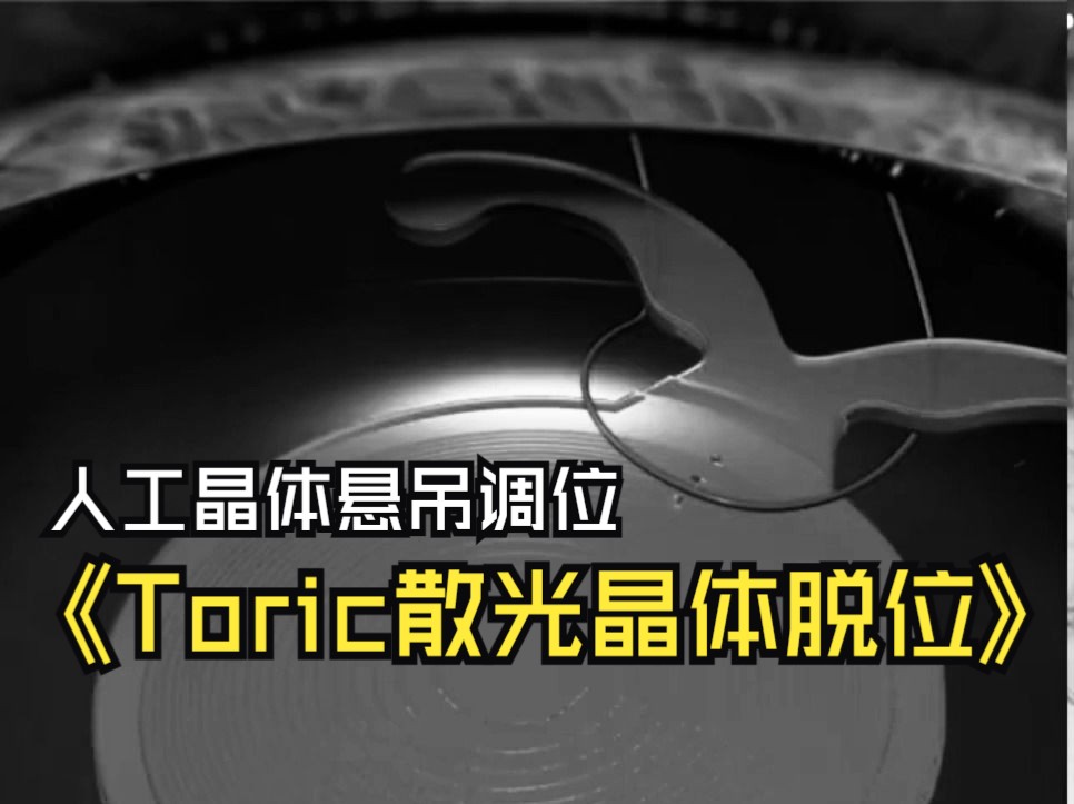 【Toric人工晶体脱位】DISLOCATED TORIC MULTIFOCAL INTRAOCULAR LENS 3D ANIMATION and STEP哔哩哔哩bilibili