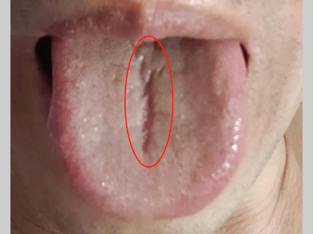 舌中根裂纹这么深,若你就认为是脾虚,那就算你补一年半载,也不会有效!