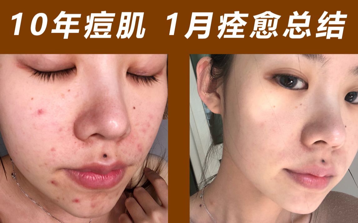 科学改善闭口痘痘过度出油十年痘肌一个月治愈的亲身经历分享