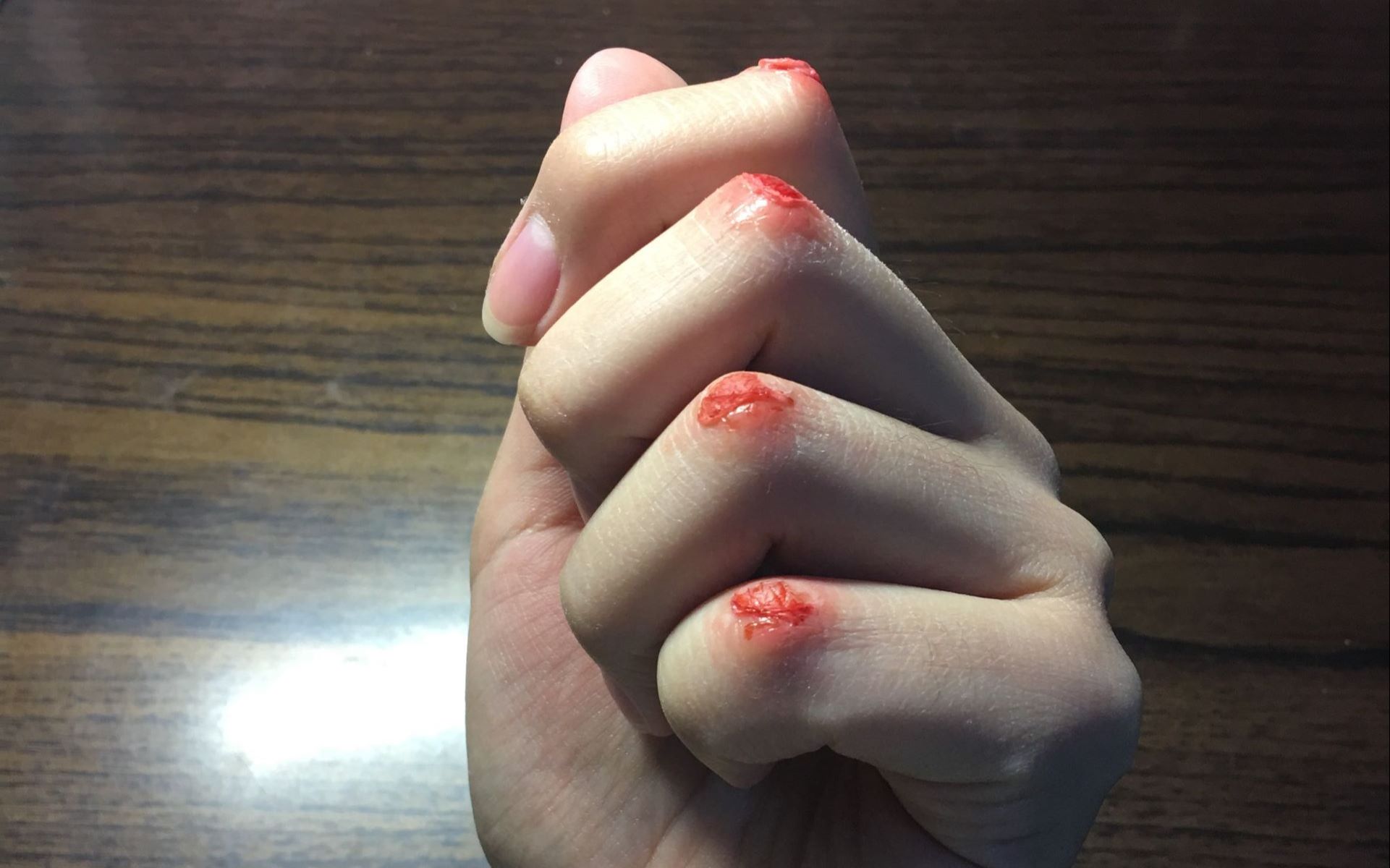 分享 收藏 硬币- 稍后看马克一下~ 用手机看离线看更方便 指关节擦伤