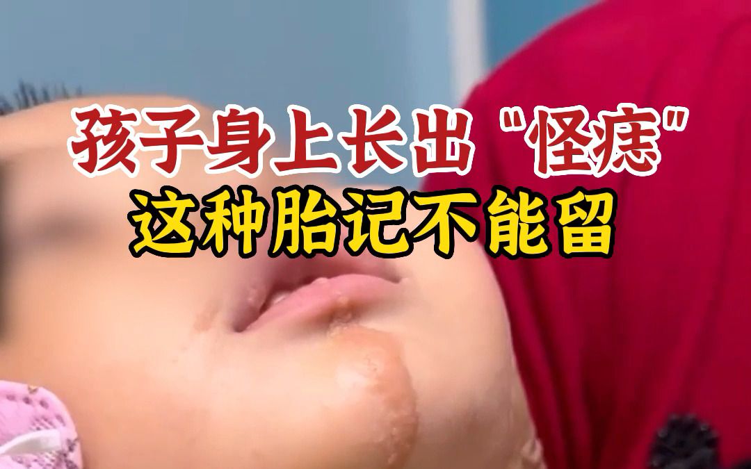 孩子身上长出“怪痣”,这种胎记不能留哔哩哔哩bilibili