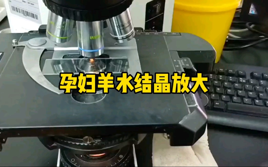 孕妇羊水结晶放大